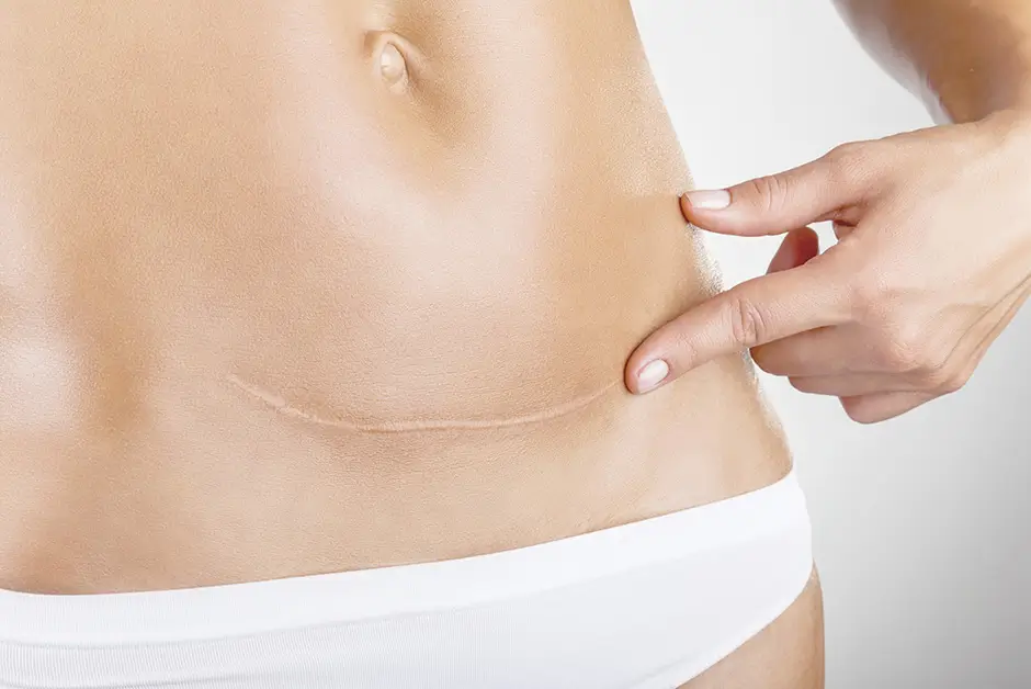 CICATRICE DUPĂ CEZARIANĂ